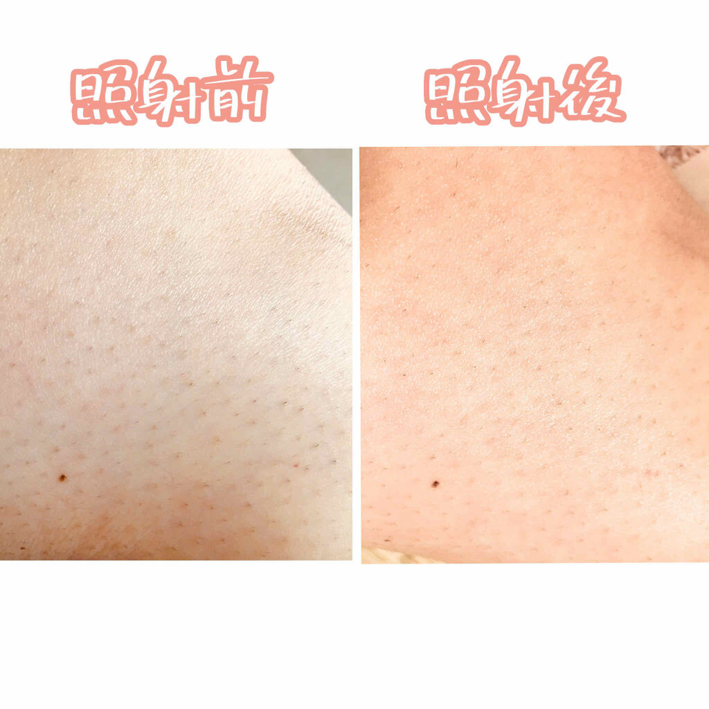 光美容器KE-NON（ケノン）/エムテック/家庭用脱毛器を使ったクチコミ（2枚目）