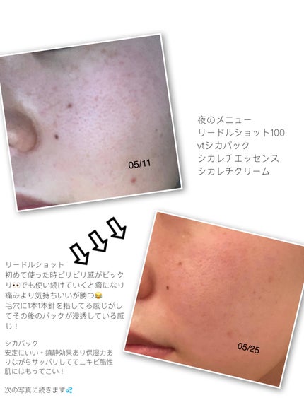 シカレチA エッセンス0.1/VT/美容液を使ったクチコミ(2枚目)