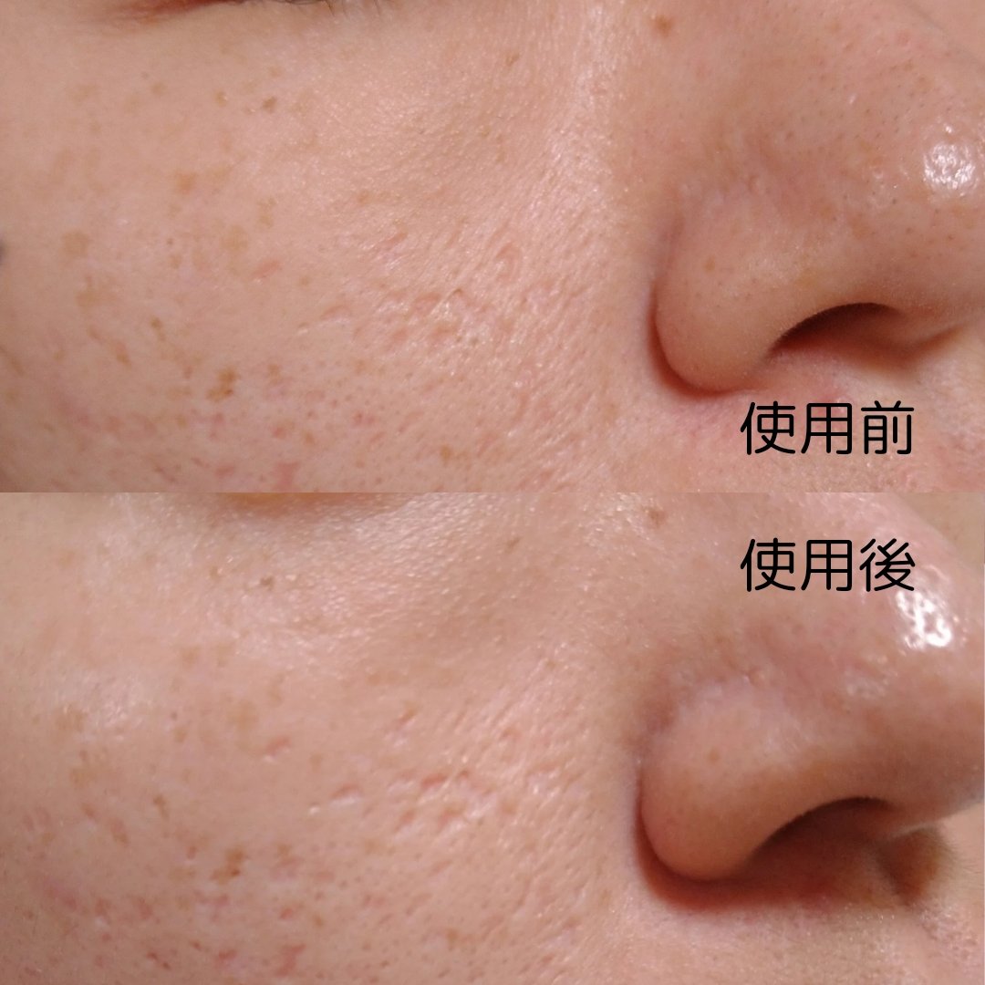 PENTA-SHOT 美顔器 ホワイト➕毛穴セラム PENTA-SHOT 美顔器 ホワイト➕毛穴セラム PENTA-SHOT 美顔器 ホワイト