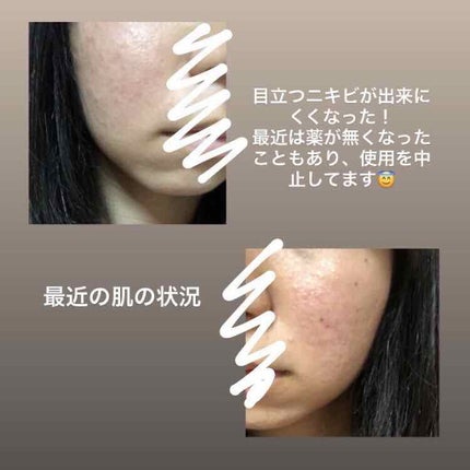 ここみ on LIPS 「#ニキビをなくそうプロジェクトニキビの薬を本格的に使い始めてか..」(2枚目)