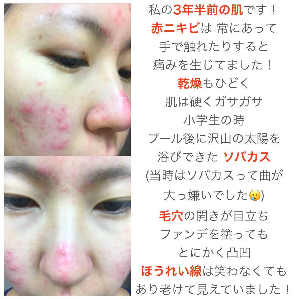 みん on LIPS 「みなさんこんにちは!今回はニキビに悩んでいた私が治った理由につ..」(2枚目)