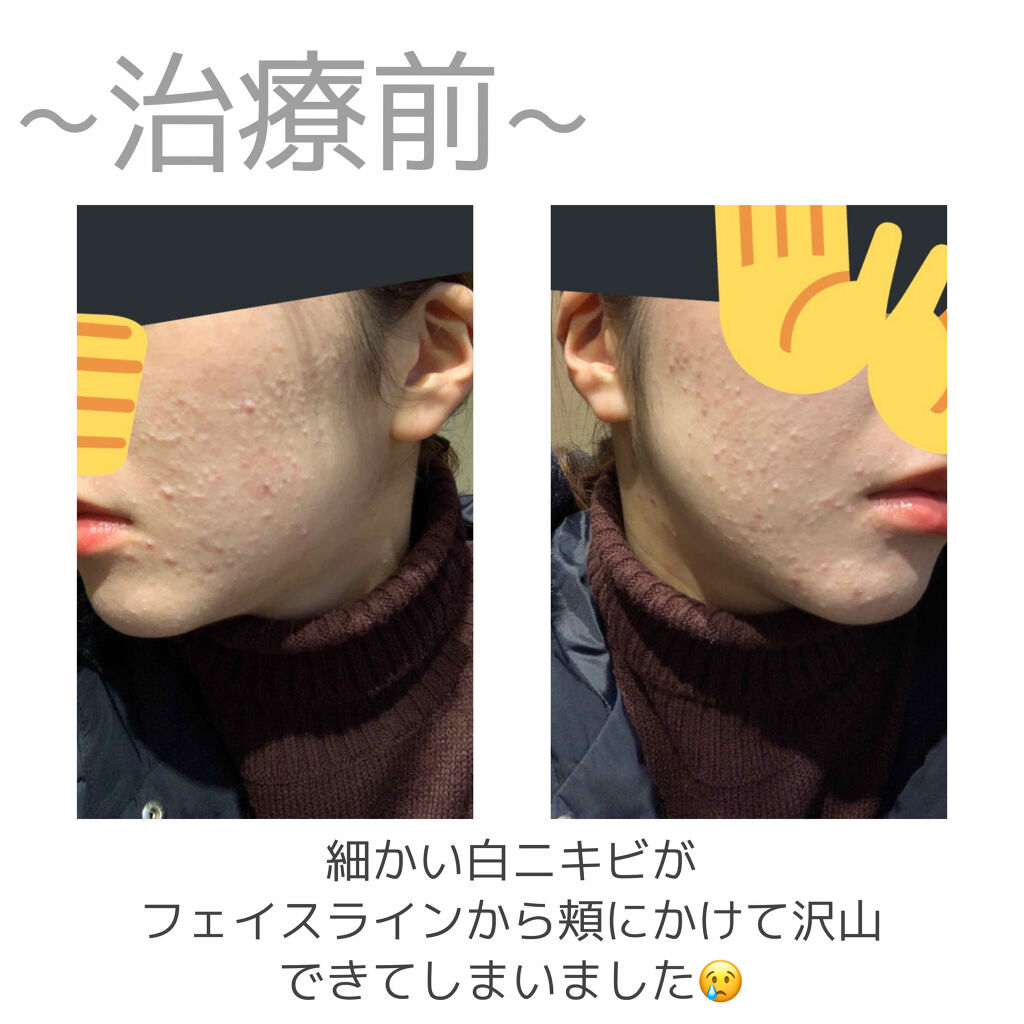 ビーソフテン ローション(医薬品)/持田製薬/その他を使ったクチコミ（3枚目）