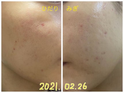 せんな on LIPS 「12年共にしたニキビ肌からさよなら!美肌目指して頑張っています..」(4枚目)