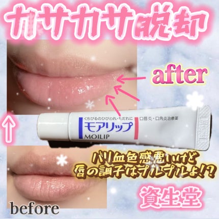 モアリップ N (医薬品)/資生堂薬品/その他を使ったクチコミ(1枚目)