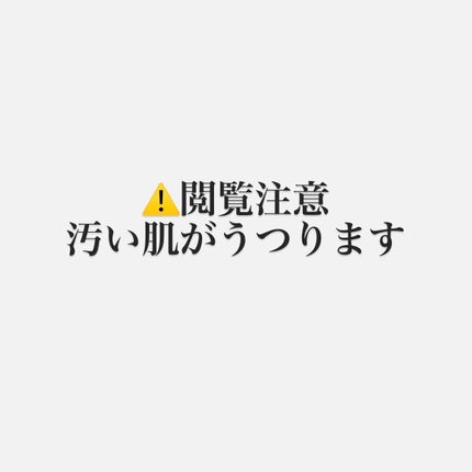 ニキビ治療薬(医薬品)/メンソレータム アクネス/その他を使ったクチコミ(2枚目)