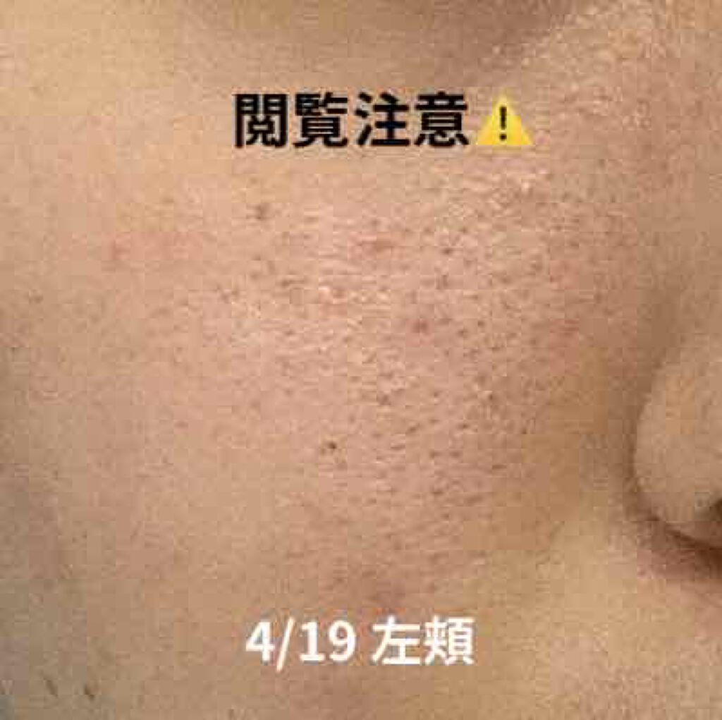 ゼロ毛穴パッド/MEDICUBE/ブースター・導入液を使ったクチコミ(2枚目)