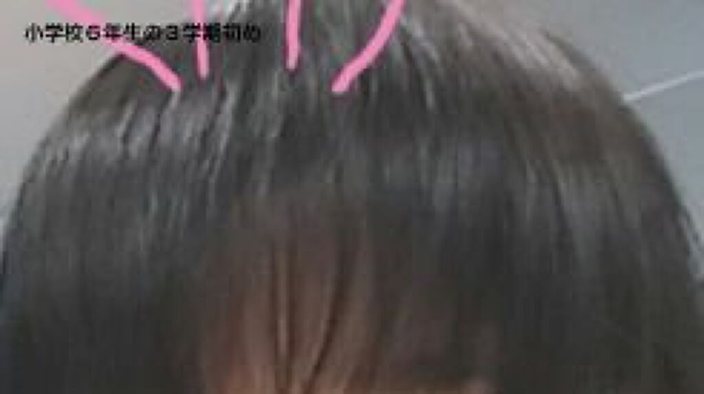 垢抜けたい女の子👧 on LIPS 「これが私の前髪の過去!!みんなこれみて元気出せ!!!!!私の現..」(3枚目)