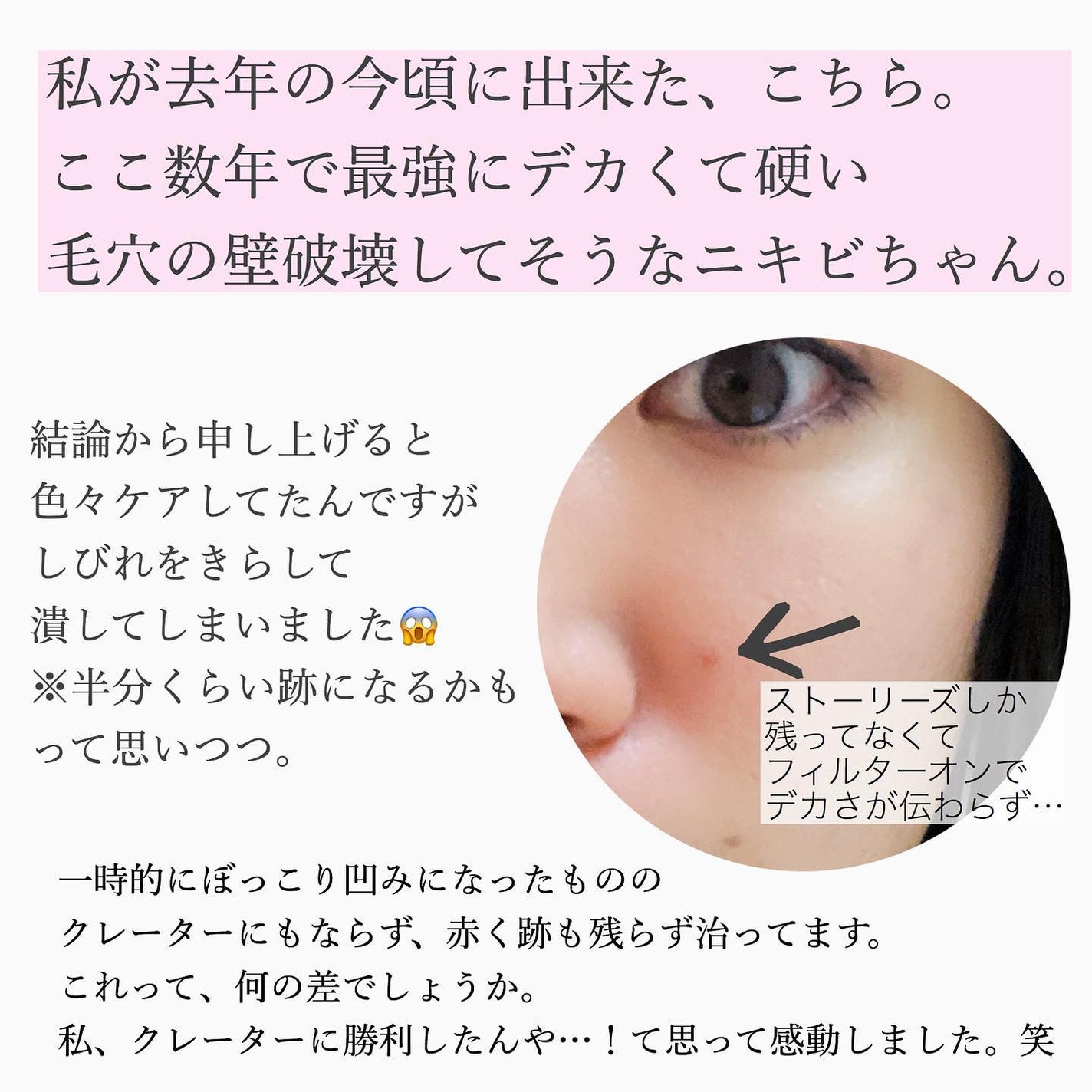 おゆみ|ニキビ・ニキビ跡ケア on LIPS 「【跡まで含めてニキビケアだよ】こんばんは。おゆみです。..」(3枚目)