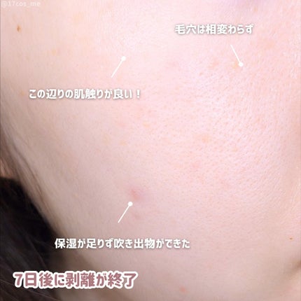 ダーマスキンピーリング/BQCELL/その他キットセットを使ったクチコミ(6枚目)