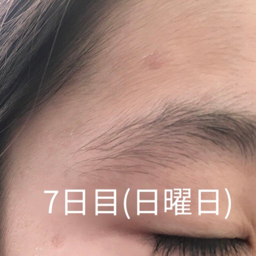 ペアアクネクリームW(医薬品)/ペア/その他を使ったクチコミ(5枚目)