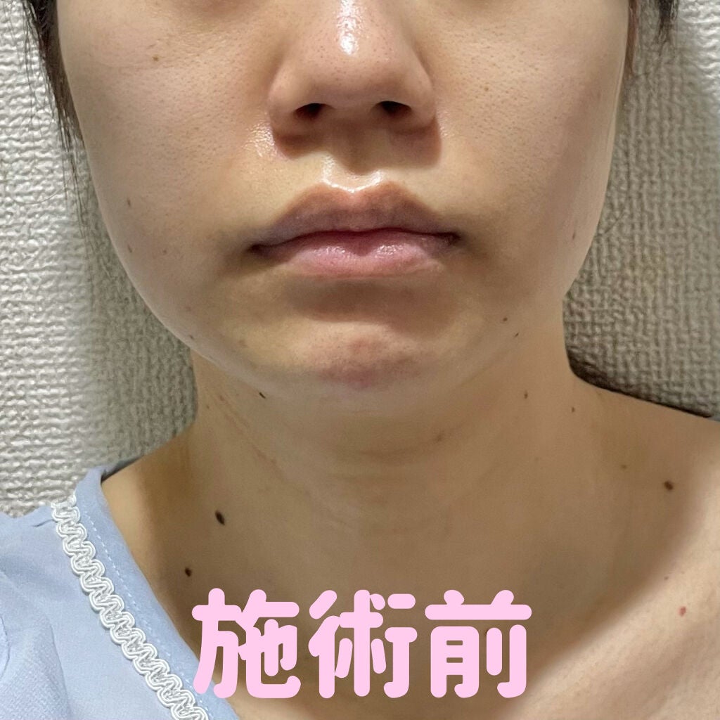 Tomomi on LIPS 「はじめての美容医療〜脂肪溶解リニアHIFU〜皆さんこんにちは😊..」(3枚目)