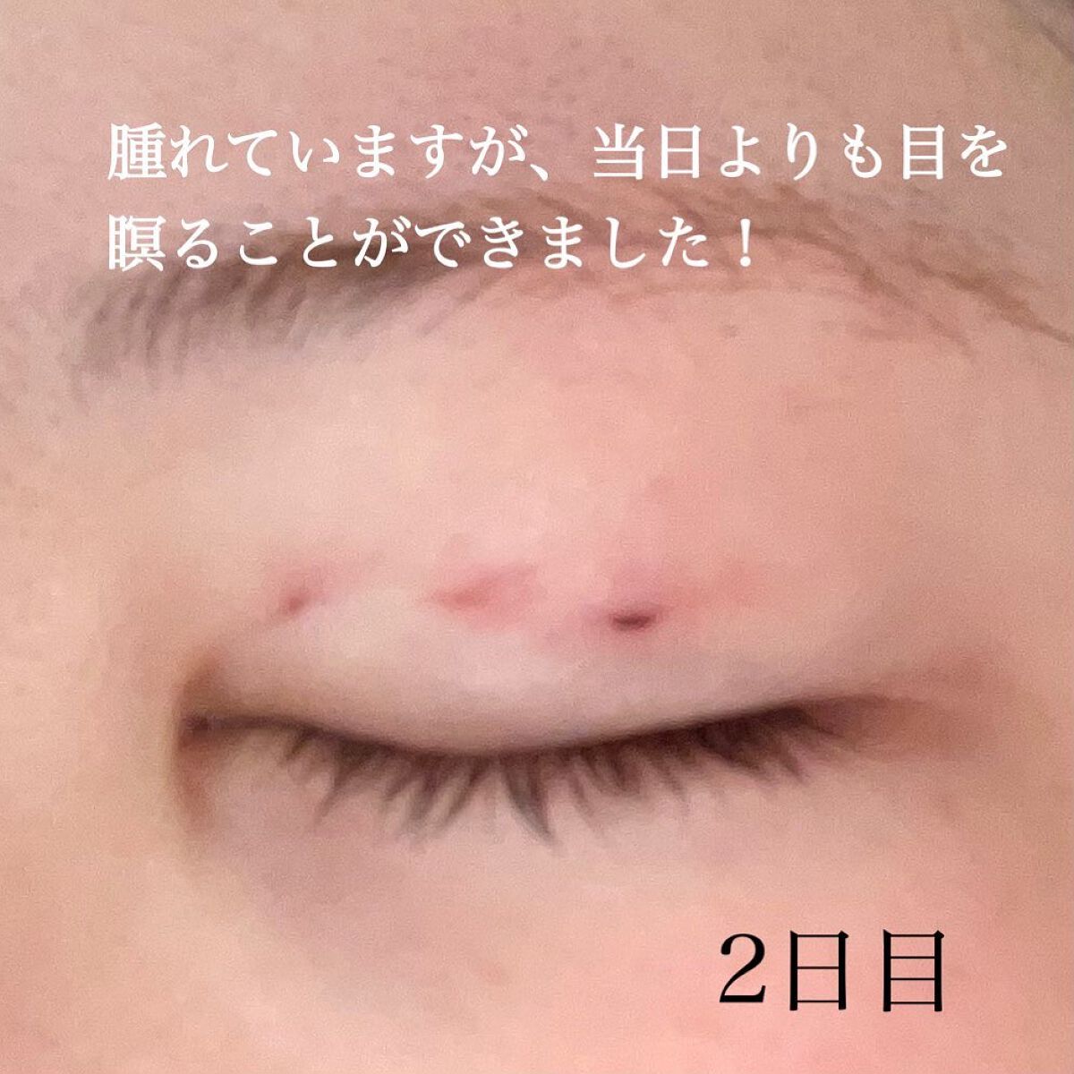 すぅ on LIPS 「私は、4年前から少しずつプチ整形も含めて、整形しています!20..」(6枚目)