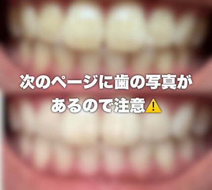 クレスト3Dホワイトニング ホワイトストリップ プロフェッショナル エフェクツ/クレスト/その他オーラルケアを使ったクチコミ(2枚目)