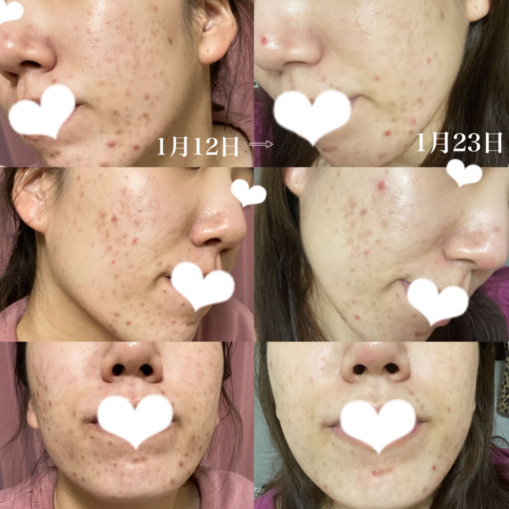 usagi on LIPS 「こんばんは🐰🤍おひさしぶりの更新です♬今日は肌の変化についてで..」(2枚目)