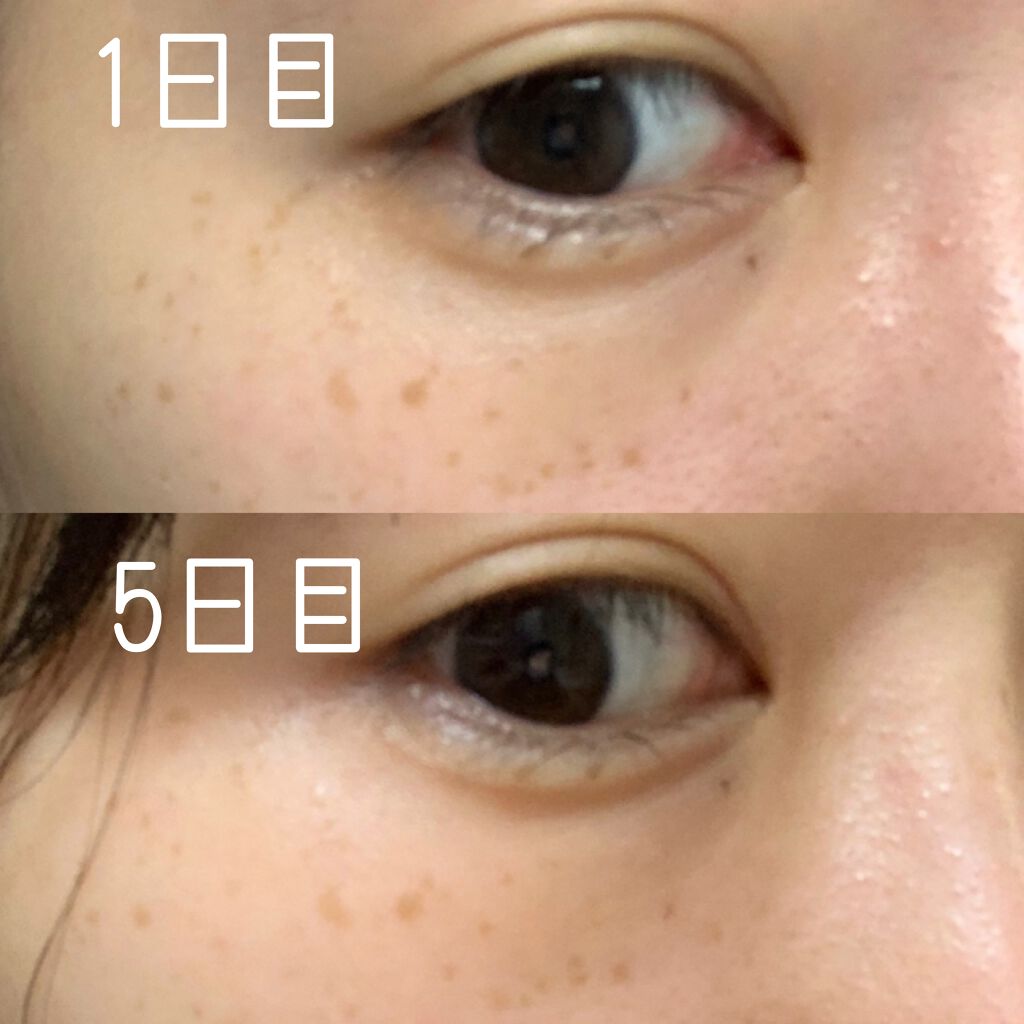 薬用ホワイトニングエッセンスEXII/トランシーノ/美容液を使ったクチコミ(2枚目)