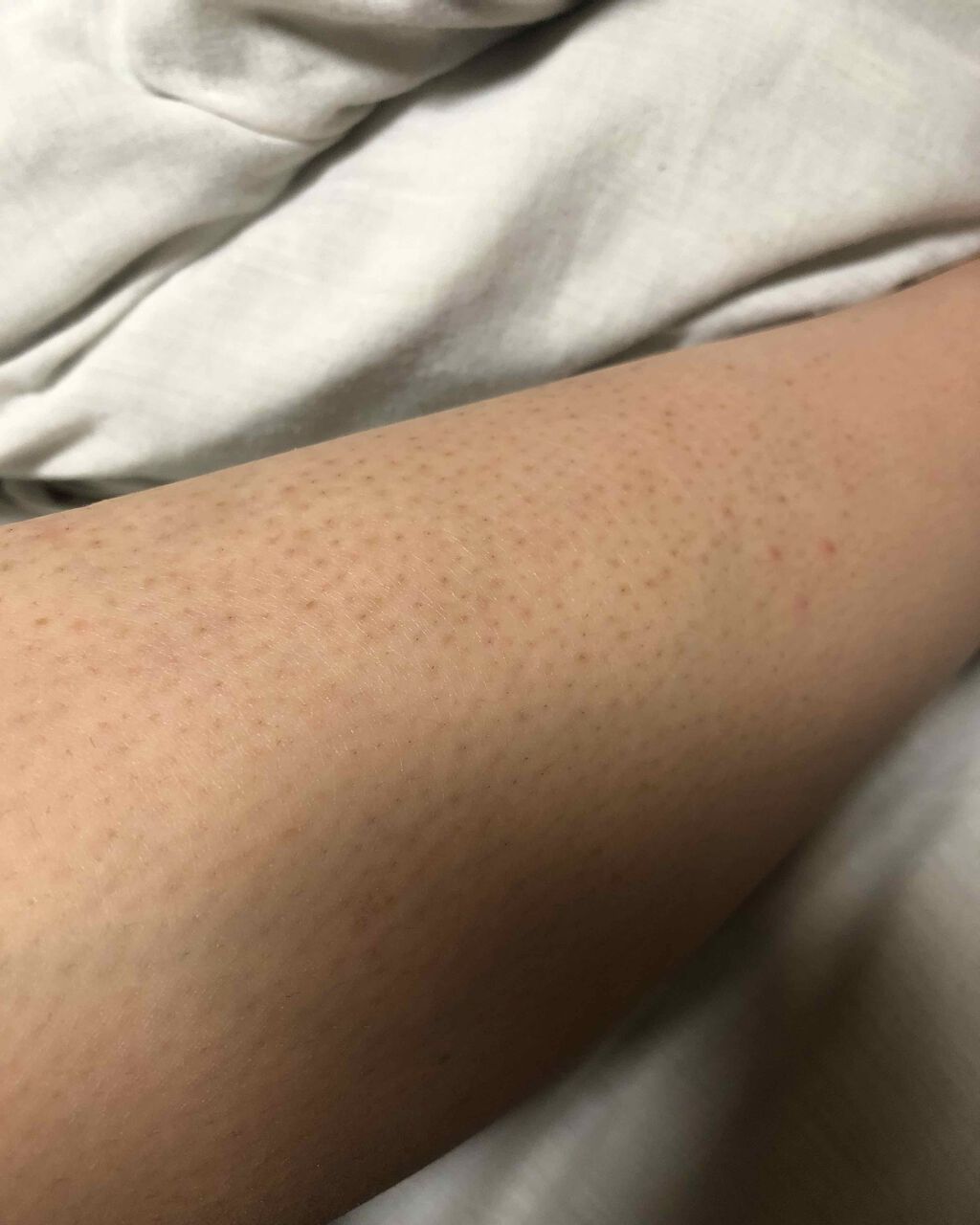 ケアノキュア（医薬品）/小林製薬/その他を使ったクチコミ（1枚目）