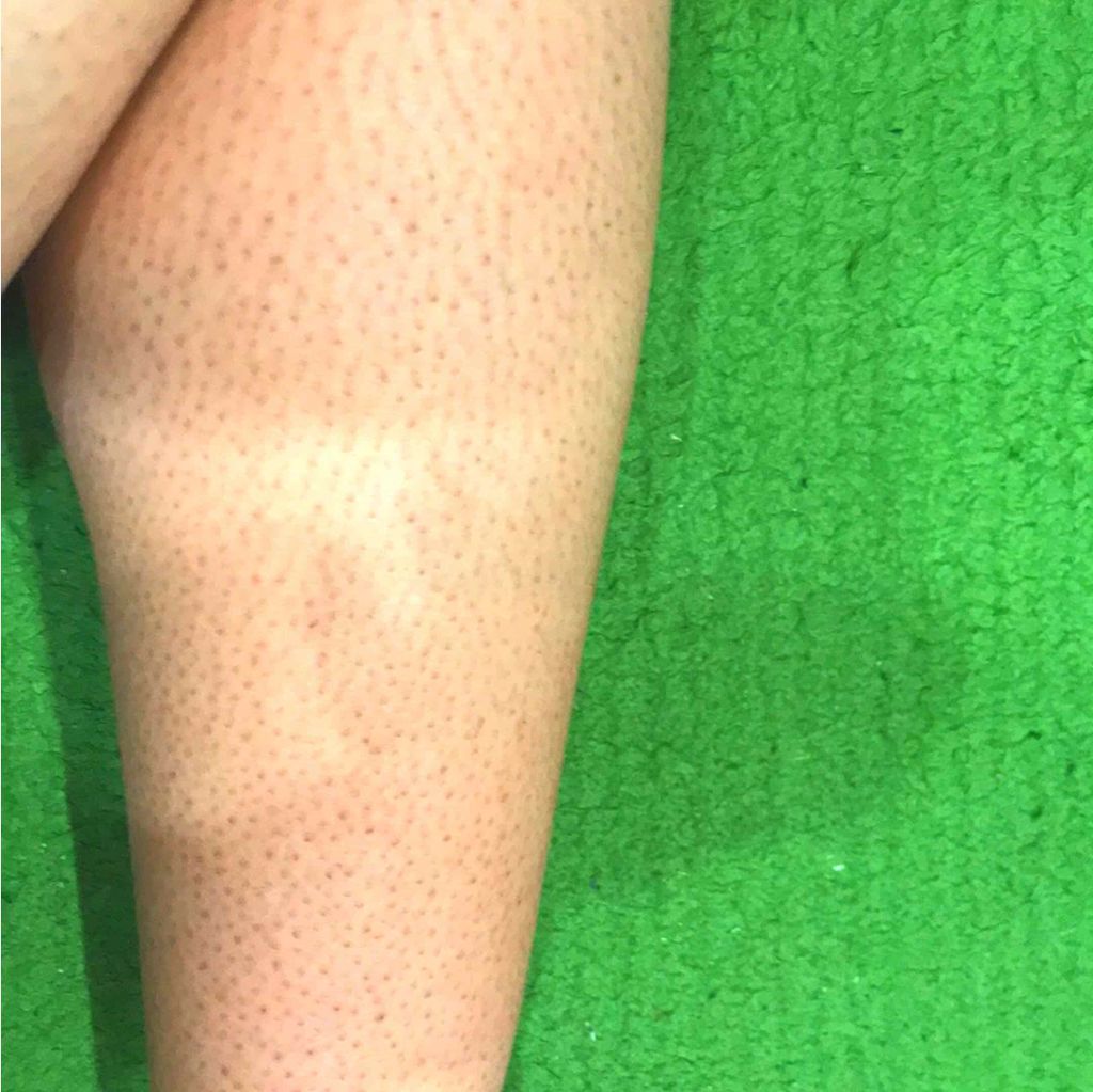 ユリン on LIPS 「1週間経ったので報告します!!感想量が少ない、効果腕あり、足あ..」(3枚目)