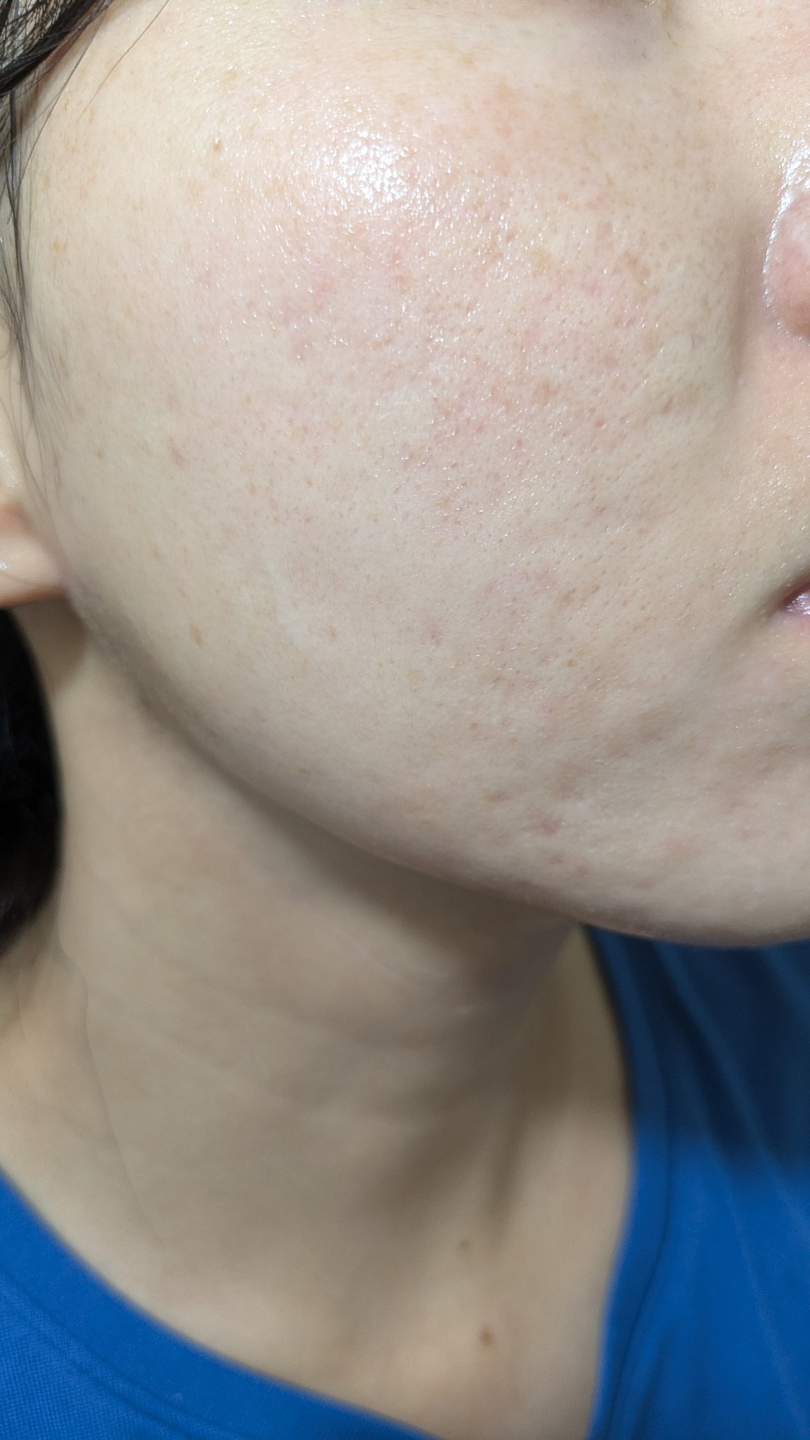 A2+NAG2ソリューション/The Ordinary/美容液を使ったクチコミ（1枚目）