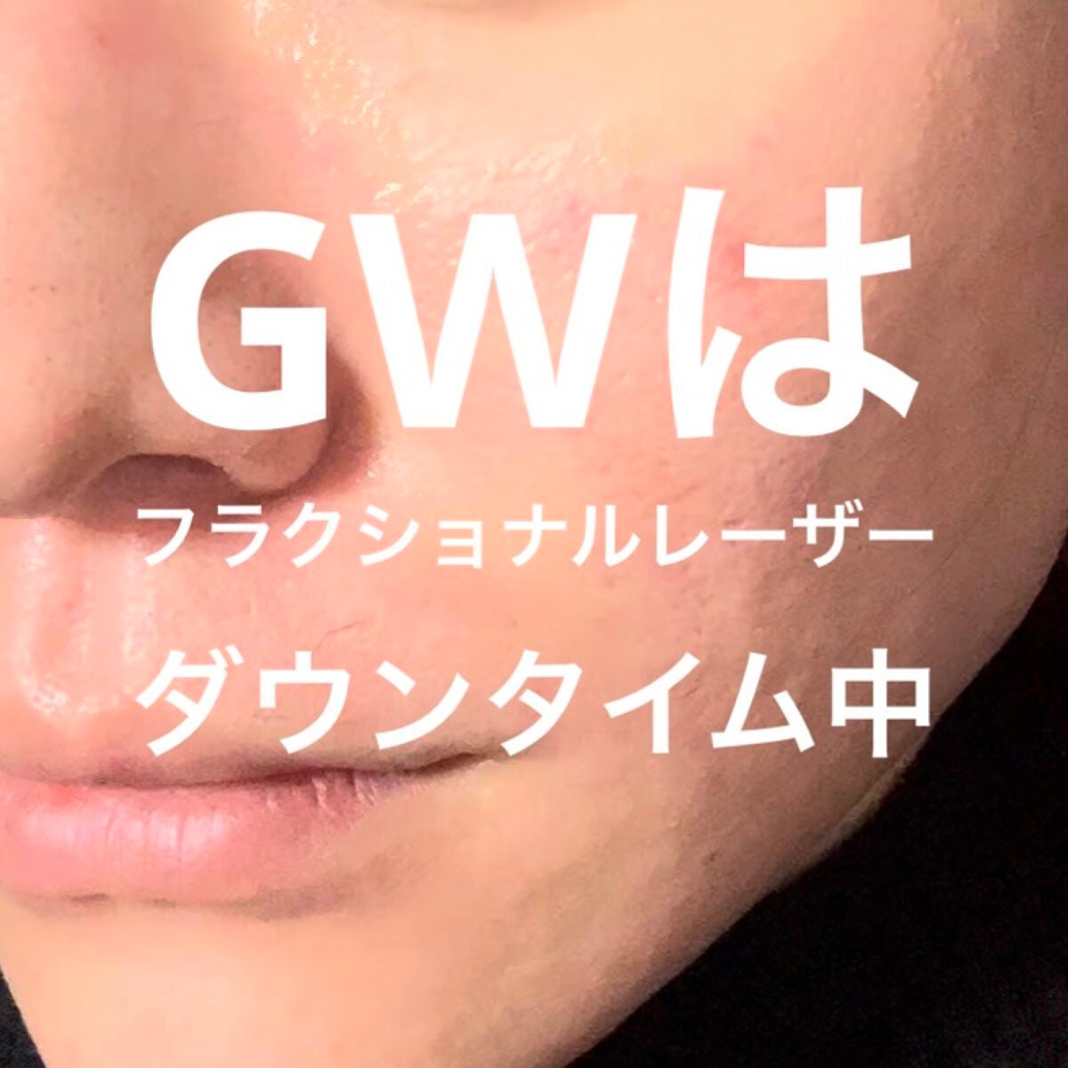 Saechangman on LIPS 「長期休暇の過ごし方いつも長期休暇はフラクショナルレーザーを初日..」(1枚目)