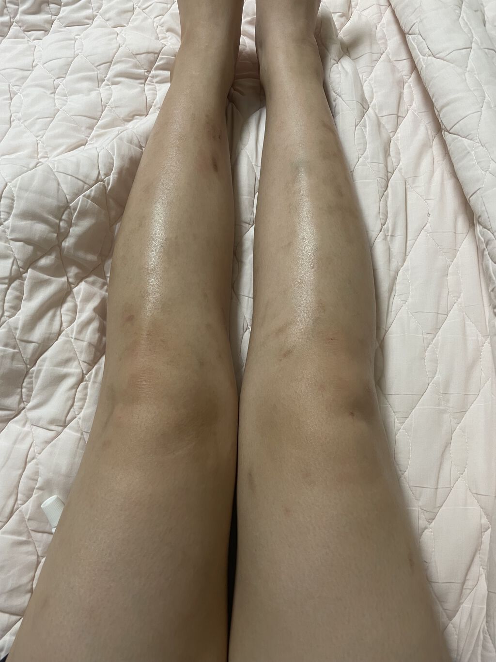 アットノンEX クリーム(医薬品)/アットノン/その他を使ったクチコミ（2枚目）