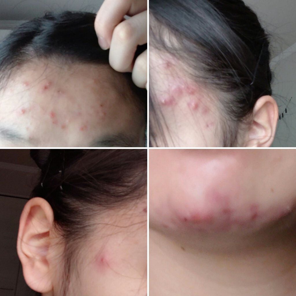 わ た あ め 。 on LIPS 「※2枚目閲覧注意です。12月20日日曜日からニキビ日記を投稿し..」(2枚目)