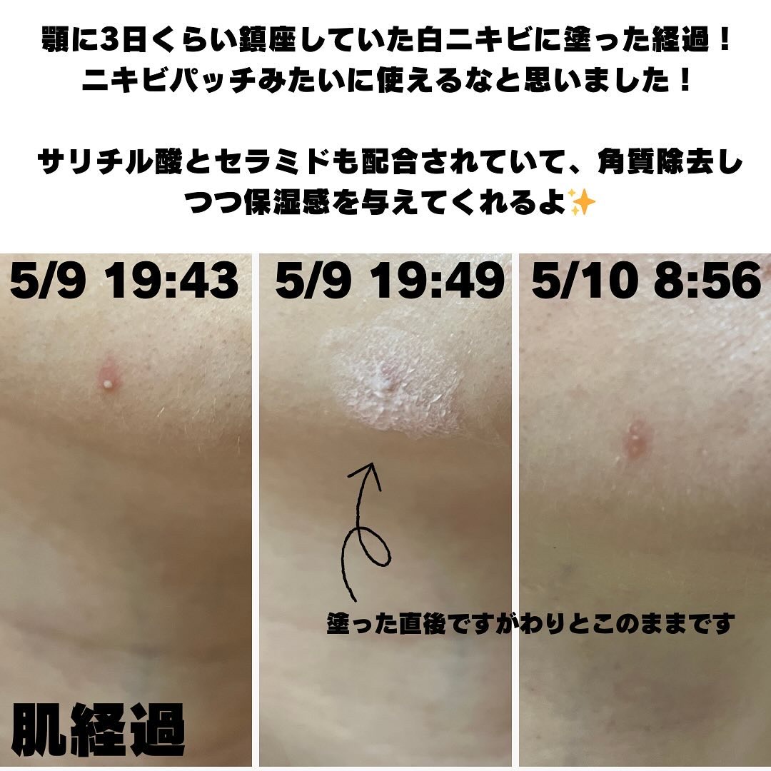 カラミンスポットパウダー/Dr.Althea/その他スキンケアを使ったクチコミ（3枚目）