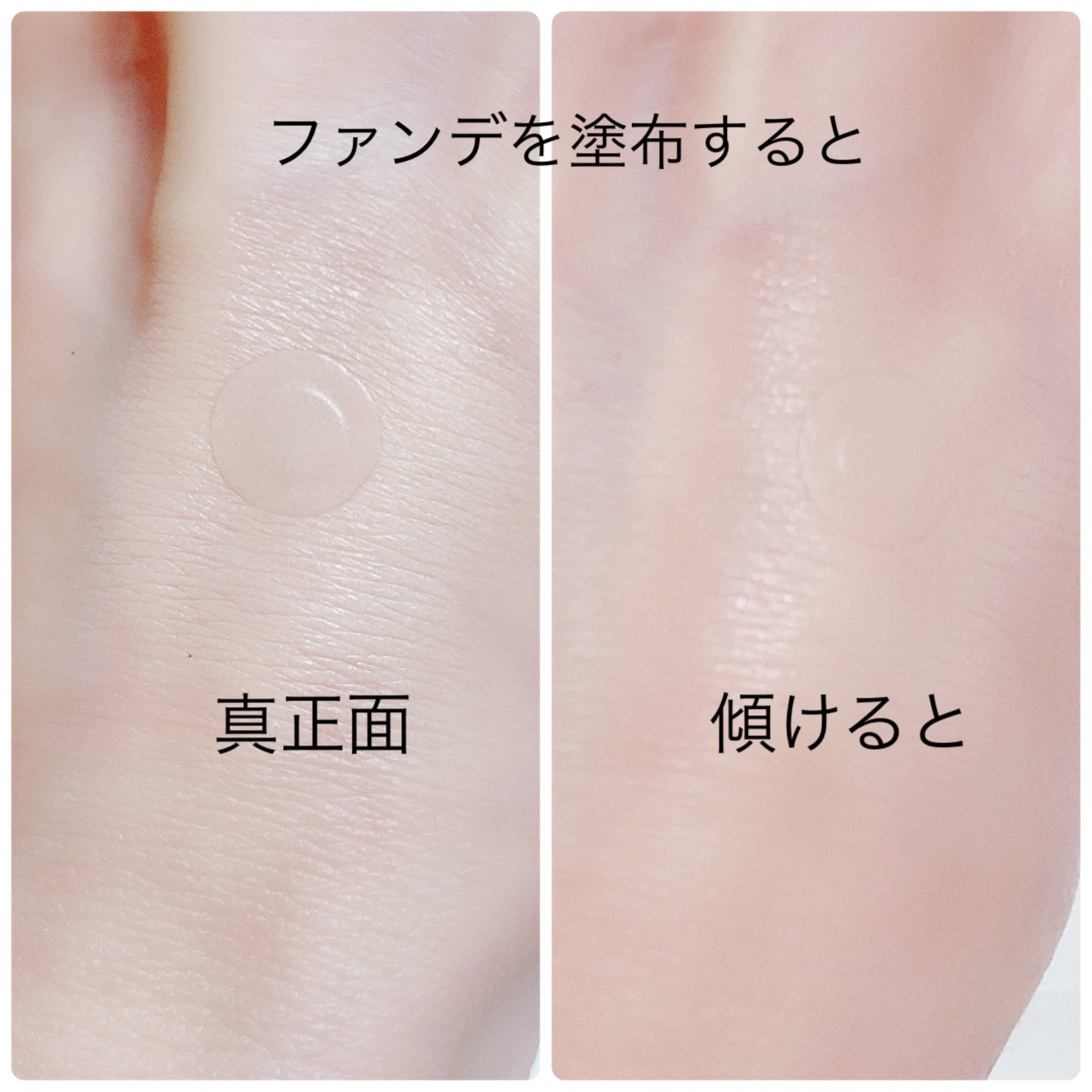 珈琲豆♡ on LIPS 「NOLAHOURスポットイレイザーニキビを3段階に分類し、段階..」(4枚目)