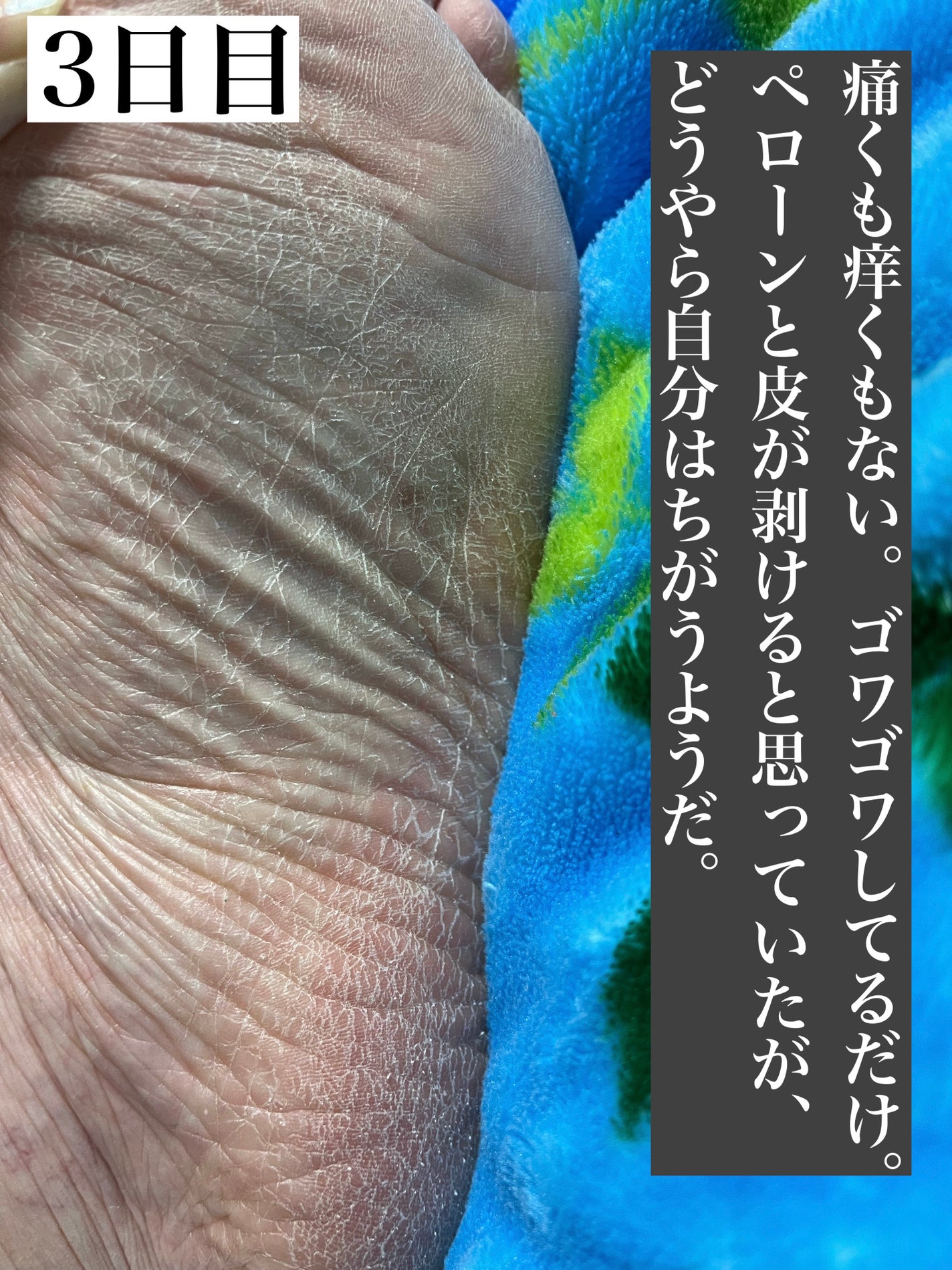 イージーパックDP60分タイプ/ベビーフット/レッグ・フットケアを使ったクチコミ(7枚目)