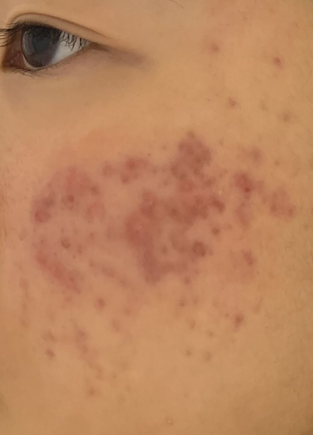 ヒルマイルドクリーム(医薬品)/健栄製薬/その他を使ったクチコミ（3枚目）