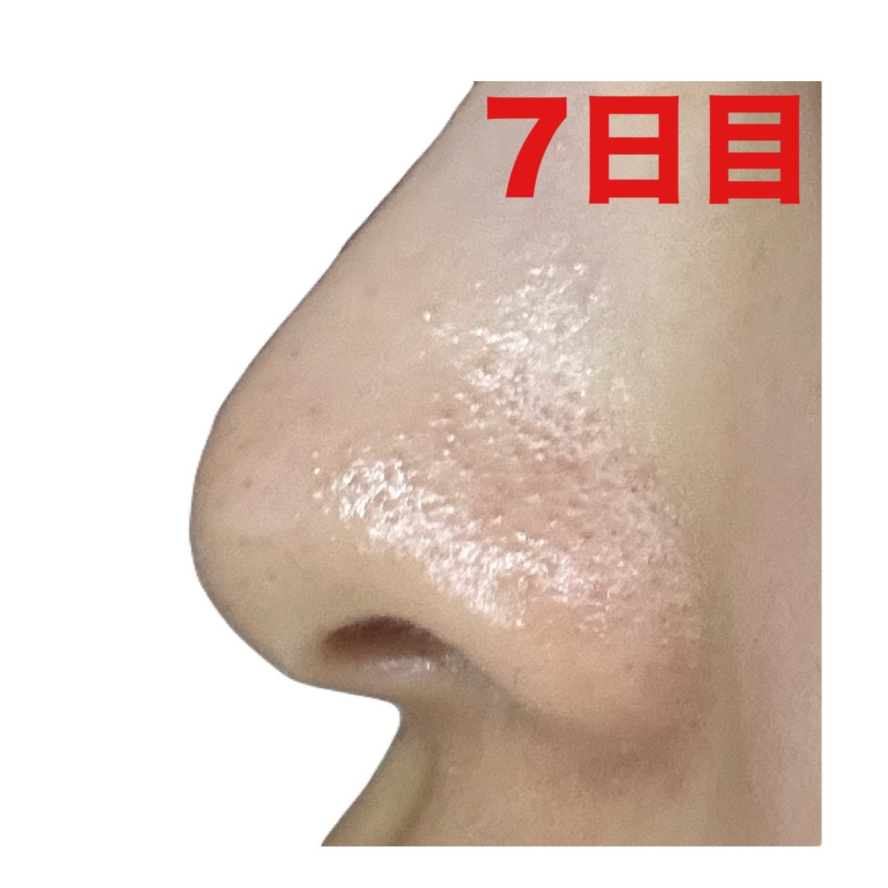 薬用 しみ 集中対策 美容液/メラノCC/美容液を使ったクチコミ(5枚目)