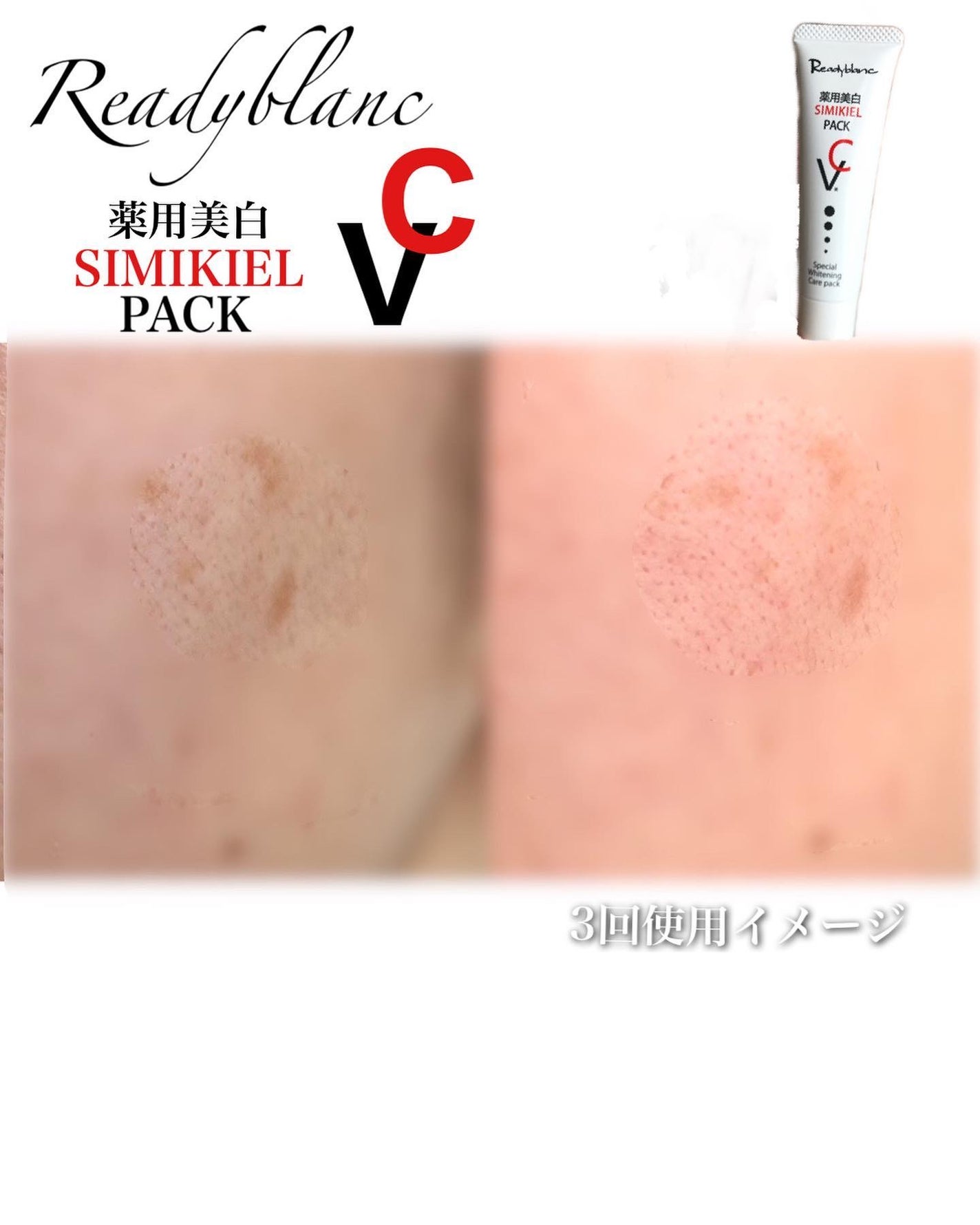 レディブラン 薬用美白シミキールパックC/シーヴァ/ピーリングを使ったクチコミ(3枚目)