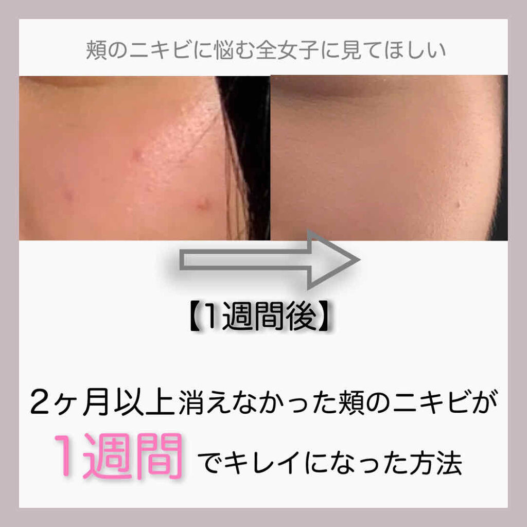 アクニドクターファーストスピーディースポット/ISOI/美容液を使ったクチコミ（1枚目）