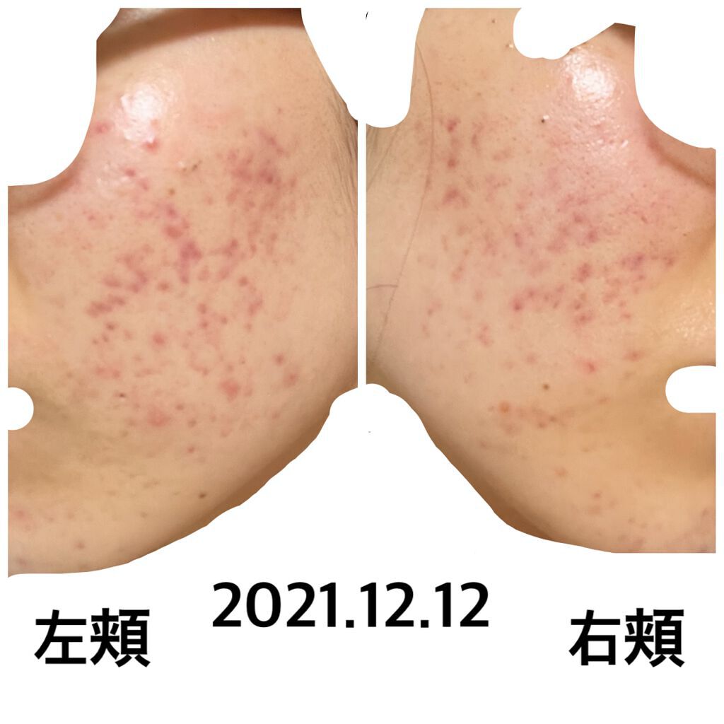 グーダルVクリーム(goodal GREEN TANGERINE V CREAM SET)/goodal/フェイスクリームを使ったクチコミ（1枚目）