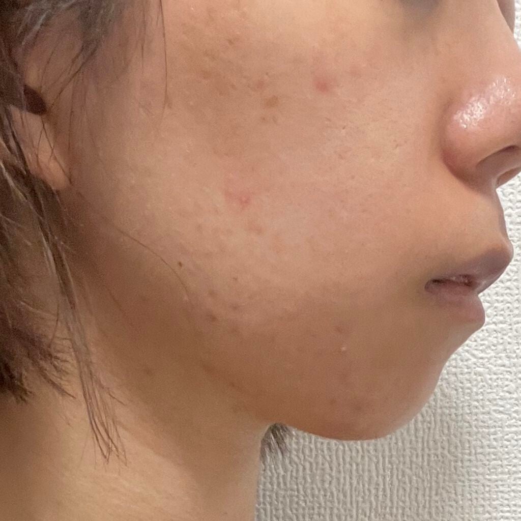 アポスティークリーム(医薬品)/アポスティー/その他を使ったクチコミ(3枚目)