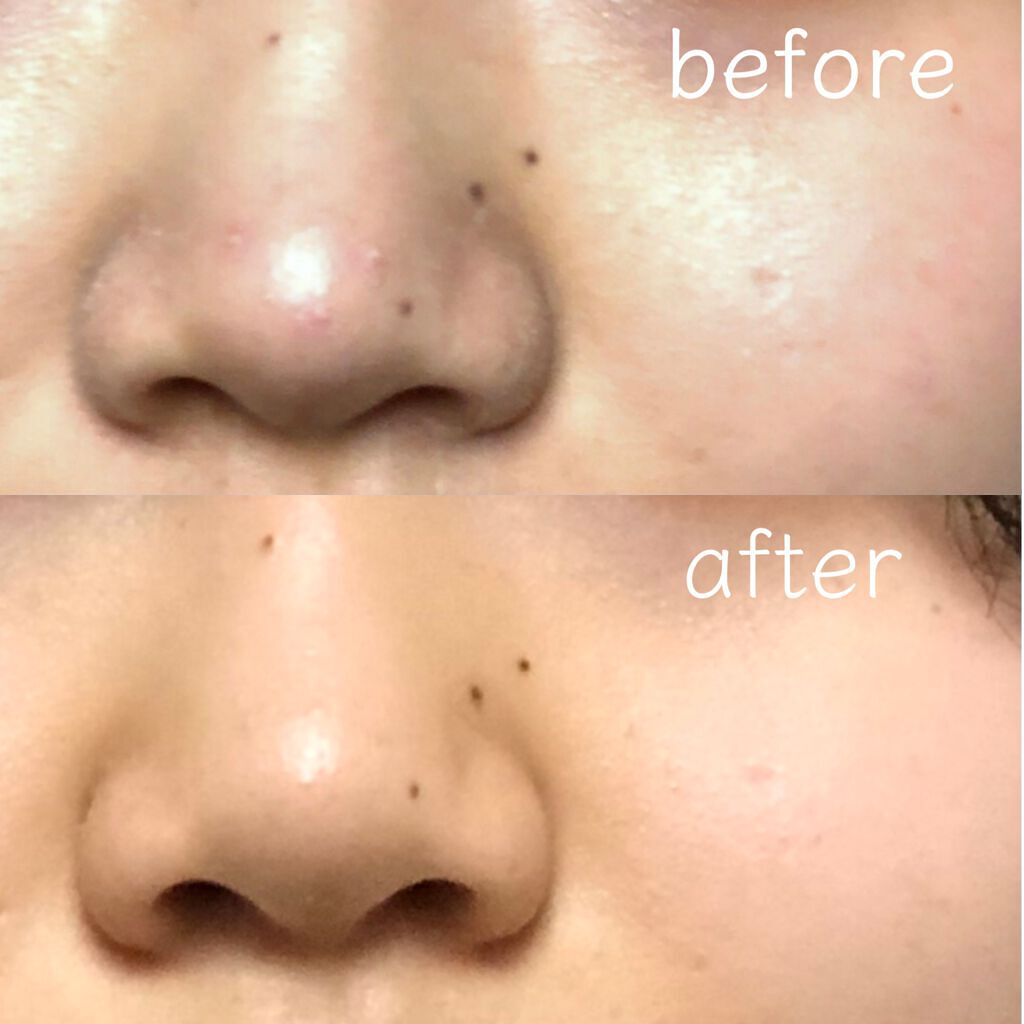 薬用 しみ 集中対策 美容液/メラノCC/美容液を使ったクチコミ（2枚目）