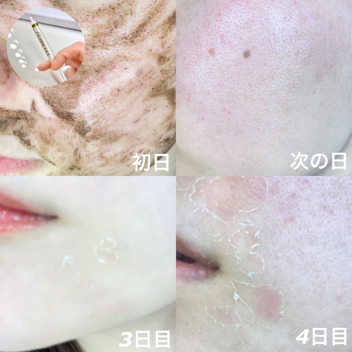 ダーマスキンピーリング/BQCELL/その他キットセットを使ったクチコミ(2枚目)