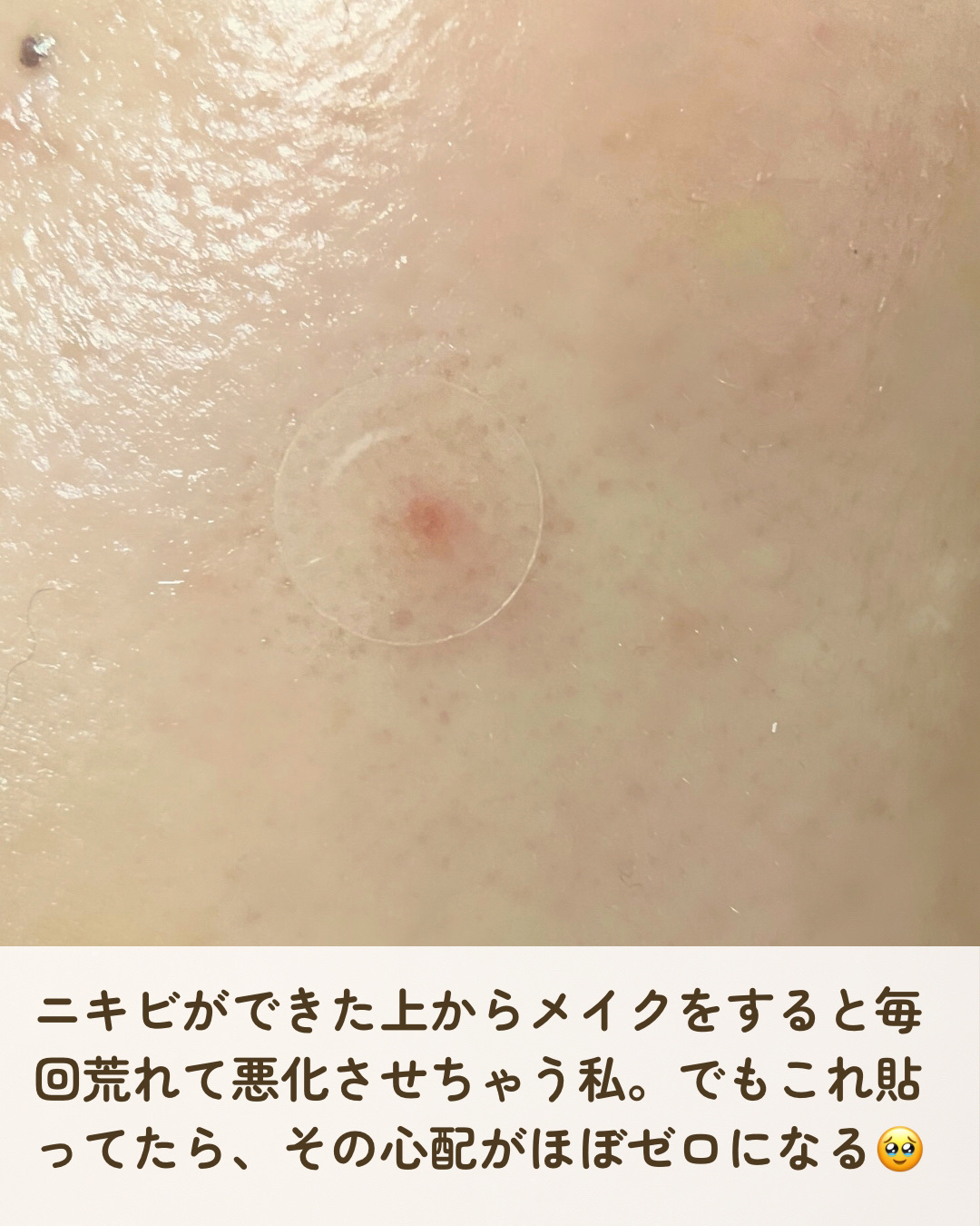 ゼロスポットパッチ/Today’s Cosme/にきびパッチを使ったクチコミ（3枚目）