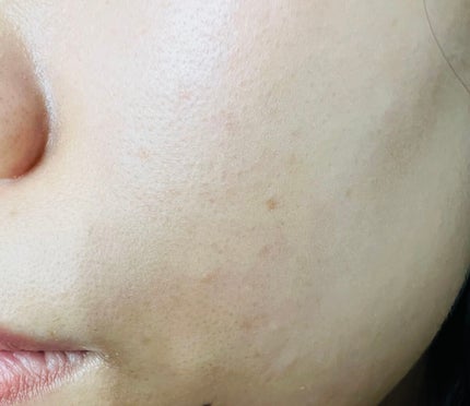 薬用アクネクリーム/NIKI PITA/フェイスクリームを使ったクチコミ(5枚目)