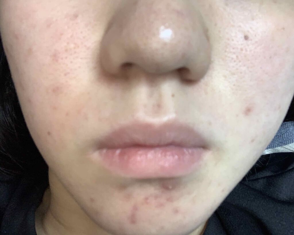 fantastic_make_out on LIPS 「2枚目以降閲覧注意です。助けてください。#ニキビ#ニキビ跡#肌..」(3枚目)