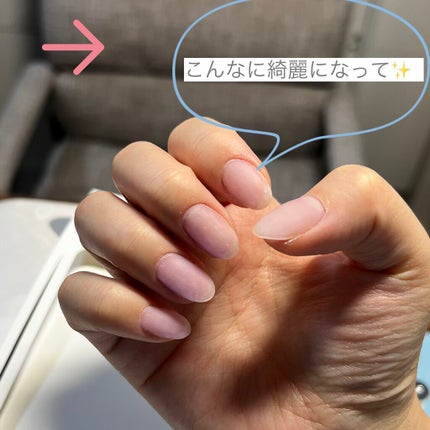 cst on LIPS 「 術後ボロボロになったつめが、、、ケアするだけ綺麗に❤️🥺💅#..」(2枚目)