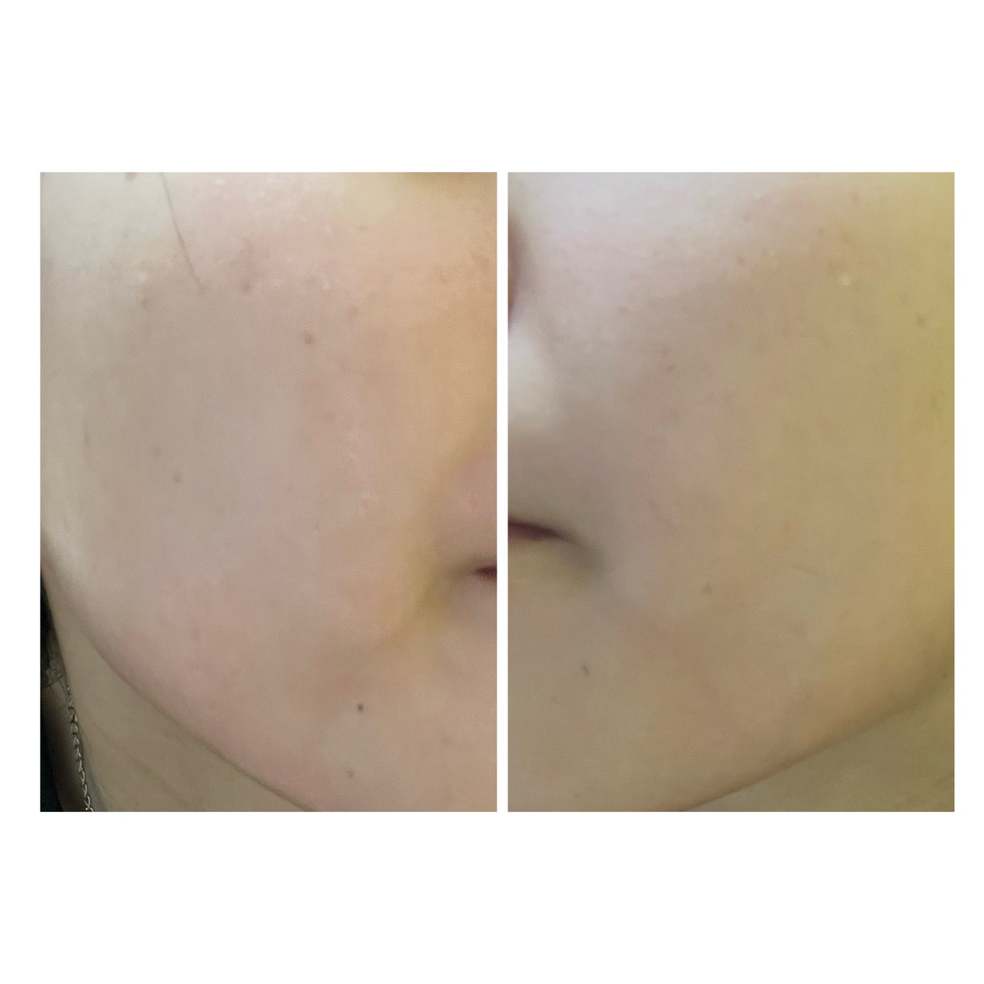 ぽむ on LIPS 「2023.9.13皮膚科に受診 エピデュオとヘパリン処方1枚目..」(1枚目)