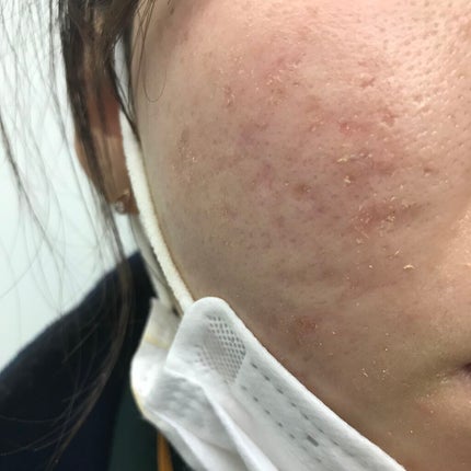 薬用 スキンケア パウダー/アクネオ/プレストパウダーを使ったクチコミ(4枚目)