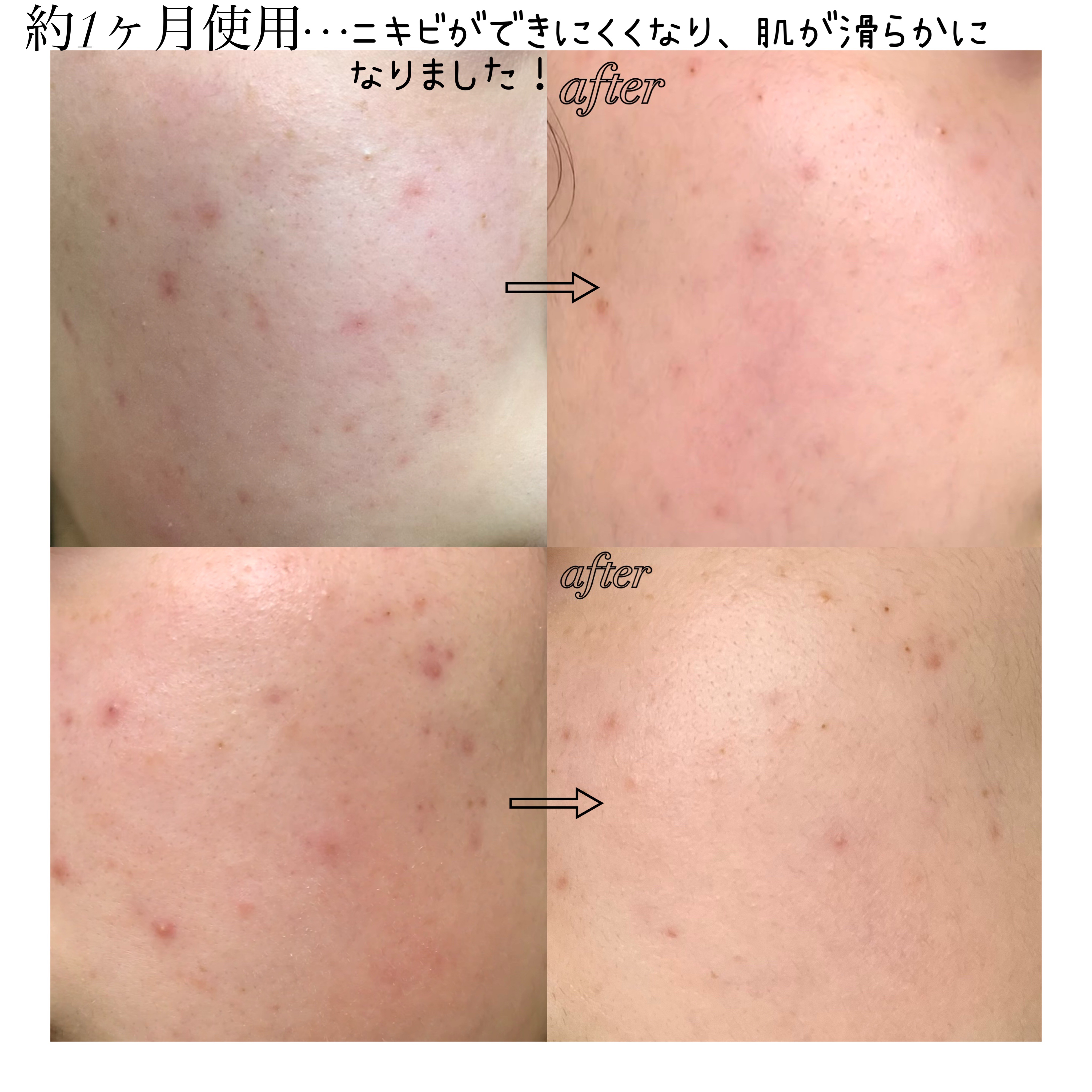 リードルショット100/VT/美容液を使ったクチコミ（3枚目）