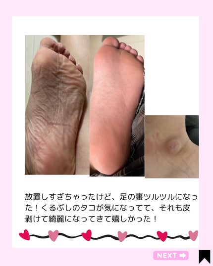 足裏角質パック グレープフルーツの香り/EVERYYOU/レッグ・フットケアを使ったクチコミ(7枚目)