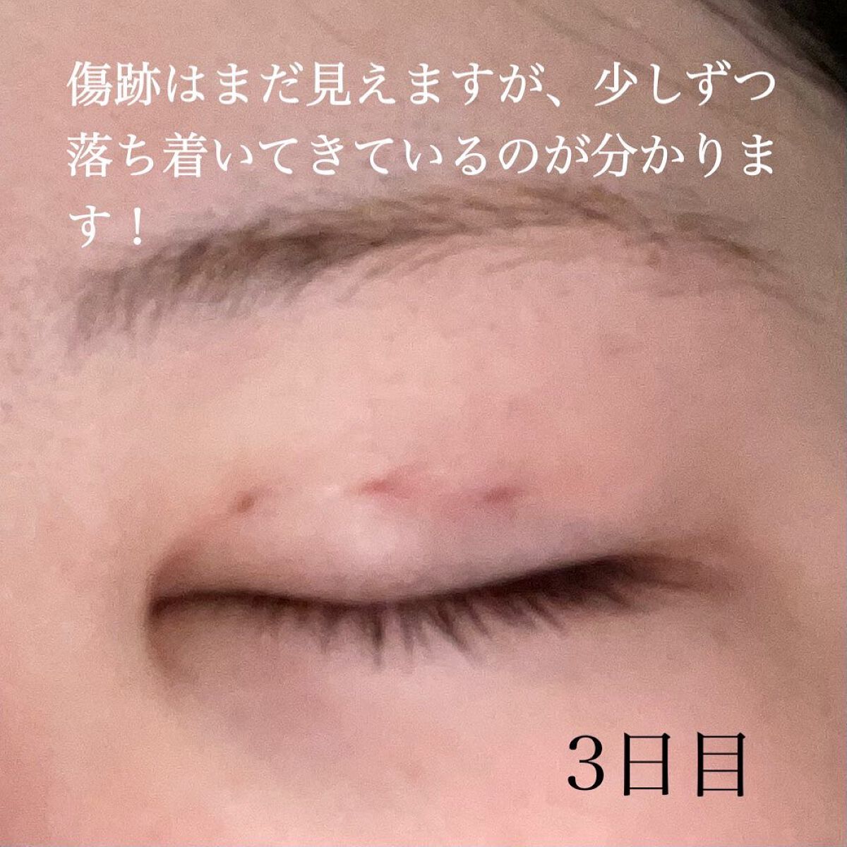 すぅ on LIPS 「私は、4年前から少しずつプチ整形も含めて、整形しています!20..」(8枚目)