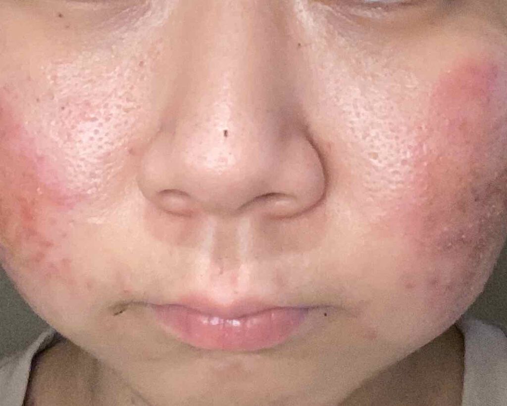 A アクネフォーム/NOV/洗顔フォームを使ったクチコミ（2枚目）