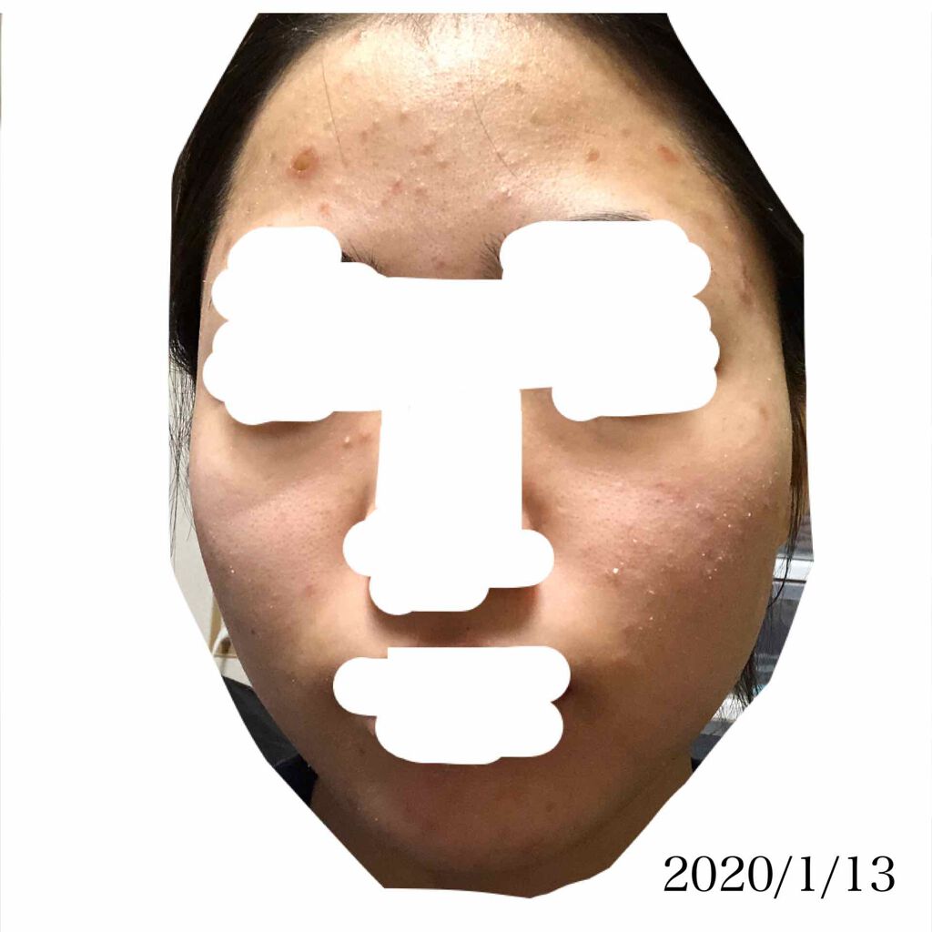 ディフェリンゲル0.1% /マルホ株式会社/その他を使ったクチコミ（3枚目）