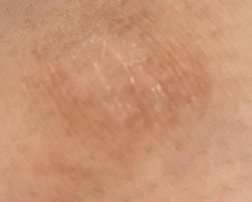 アットノンEX クリーム(医薬品)/アットノン/その他を使ったクチコミ（3枚目）