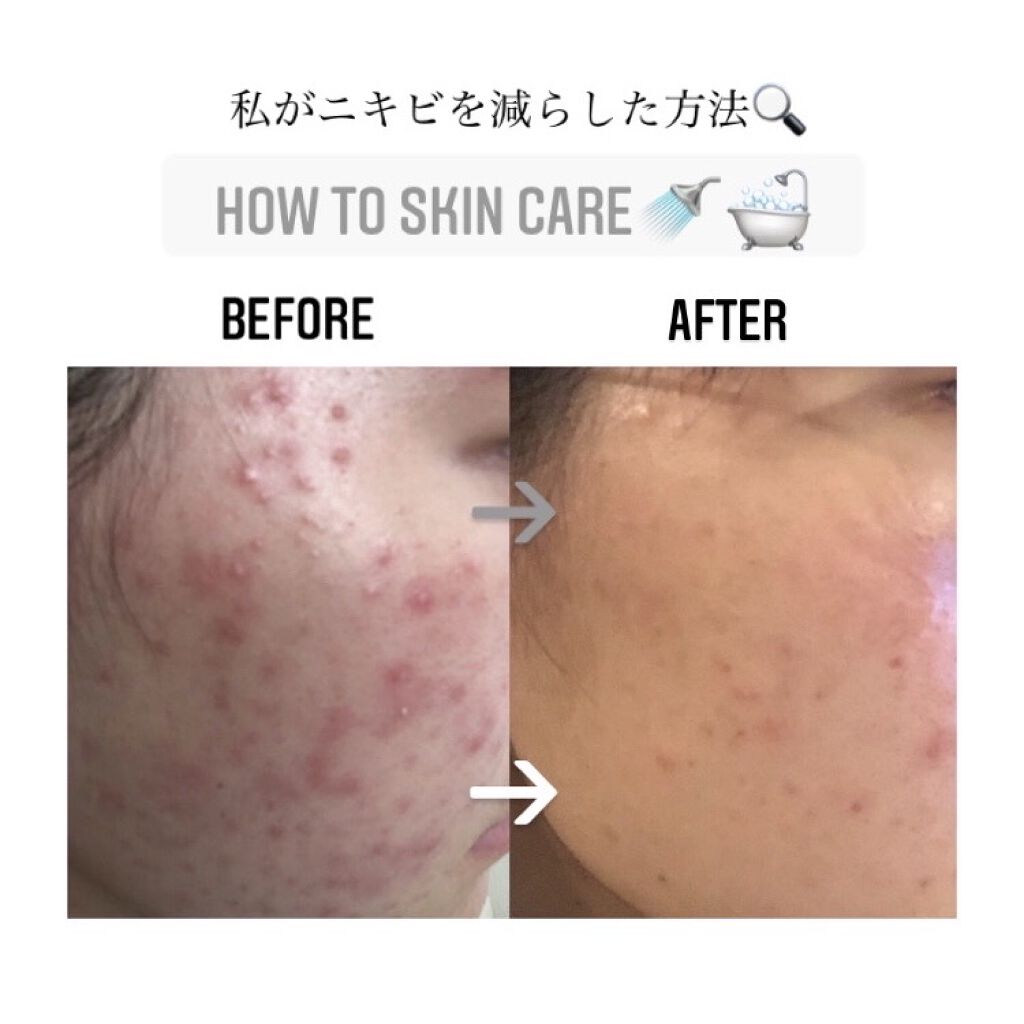 Ａ アクネジェル/NOV/美容液を使ったクチコミ（1枚目）