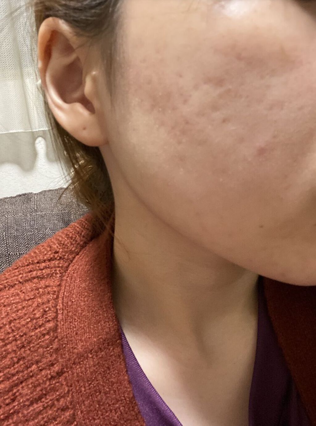 薬用アクネホワイトニング ジェル（部分用美容液）/DHC/美容液を使ったクチコミ（1枚目）